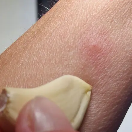 Knoblauch gegen Mückenstiche