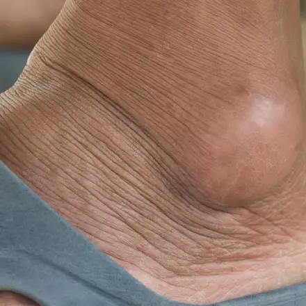 Überbein (Ganglion) wegbekommen