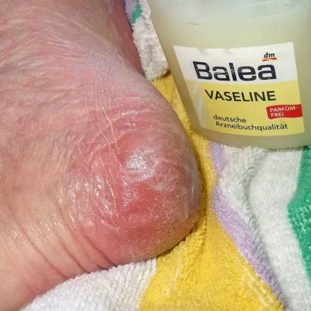 Verhornte Fersen werden über Nacht weich durch Vaseline