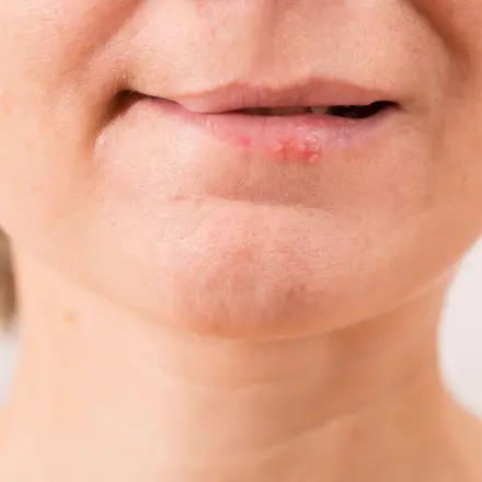 Hitze gegen Herpes