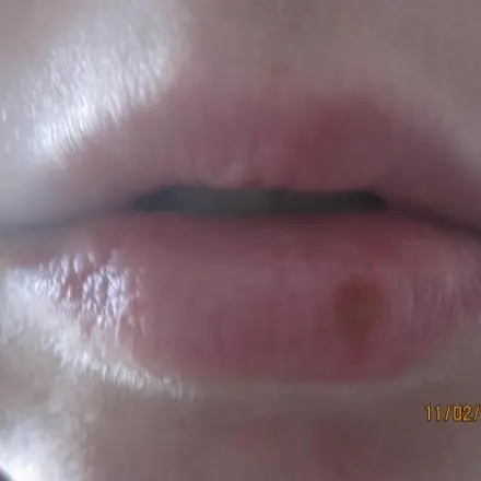 Isopropyl-Alkohol gegen Lippenherpes