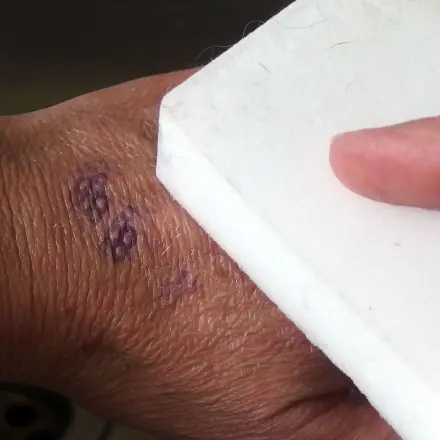 Stempel mit Schmutzradierer von der Hand entfernen