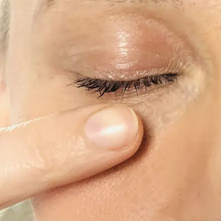 Fremdkörper aus dem Auge entfernen