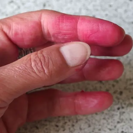 Verfärbte Finger bei Rote Beete