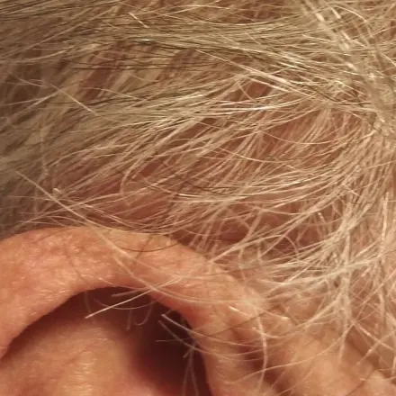 Haare - kahle Stellen