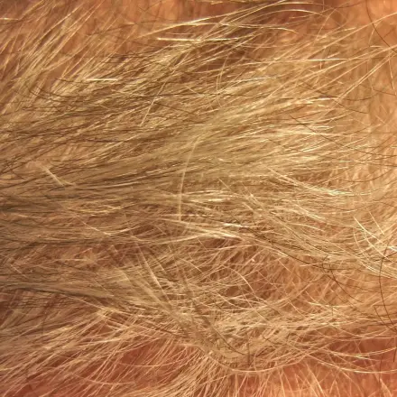 Tipp gegen Haarausfall