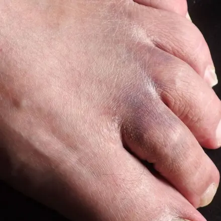 Schürfwunden und Hämatome (blaue Flecken)