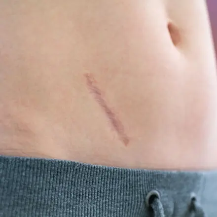 Narben pflegen