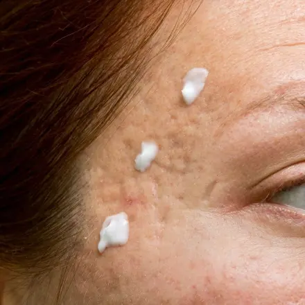 Epiduo aus der Apotheke gegen Pickel