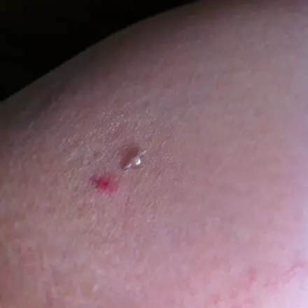 Splitter aus der Haut holen