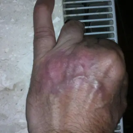 Schuppenflechte an den Händen