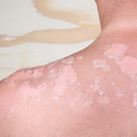 Achtung UV: Die 7 besten Tipps gegen Sonnenbrand