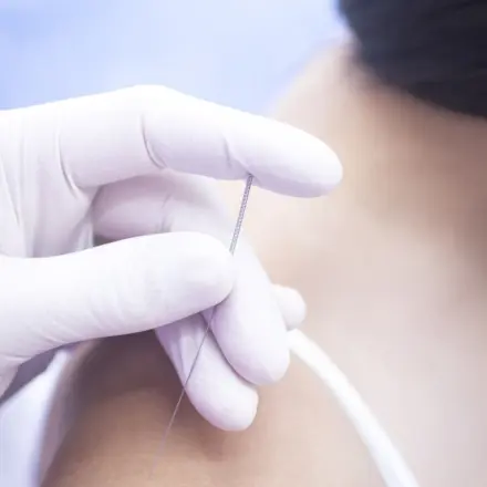 Schmerzen behandeln mit Dry Needling