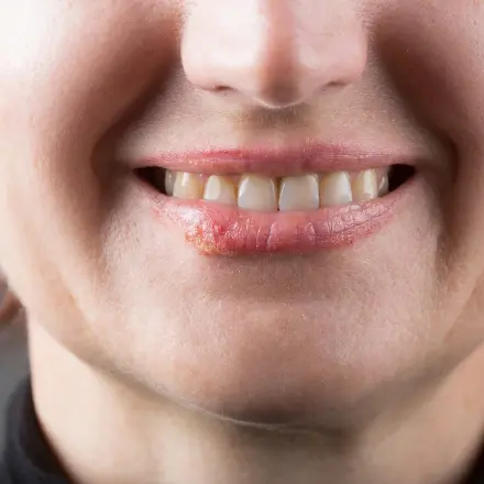 Herpes schnell bekämpfen