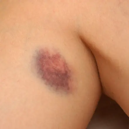 Was tun gegen blaue Flecken?