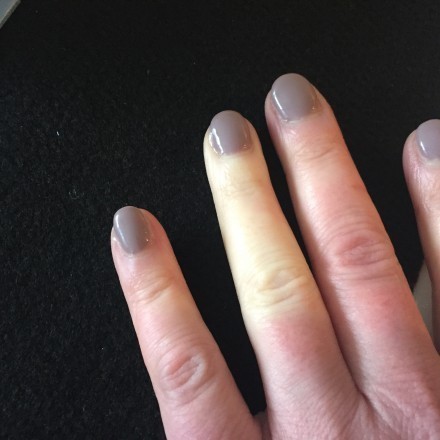 Raynaud-Syndrom: Weiße, gefühllose und eiskalte Finger, was tun?