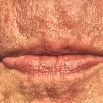 Rauhe und schmerzende Lippen