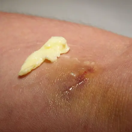 Butter gegen blaue Flecken