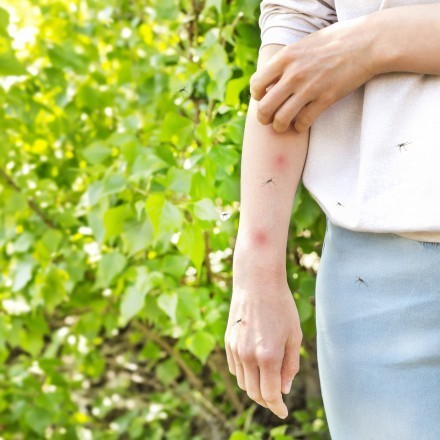 Tipps gegen das Jucken von Mückenstichen