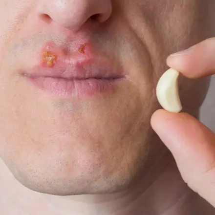 Herpes mit Knoblauch loswerden