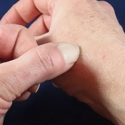 Gegen Juckreiz von Mückenstichen - Kreuzchen machen