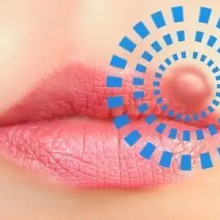 Herpes: Ballistol hilft sofort