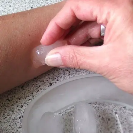 Mückenstiche - Soforthilfe