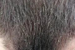 Salzwasser gegen Schuppenflechte