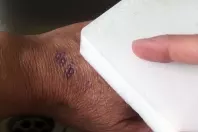 Stempel mit Schmutzradierer von der Hand entfernen