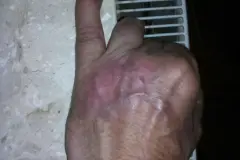 Schuppenflechte an den Händen