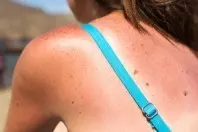 Sonnenbrand behandeln: 3 Tipps zum Schmerzen lindern
