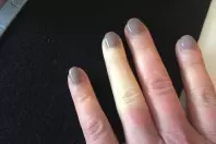 Raynaud-Syndrom: Weiße, gefühllose und eiskalte Finger, was tun?